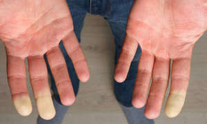La maladie de Raynaud - Symptômes, et solutions naturelles